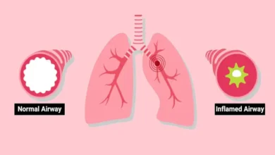 Is Bronchitis Contagious? Learn About Its Transmissibility