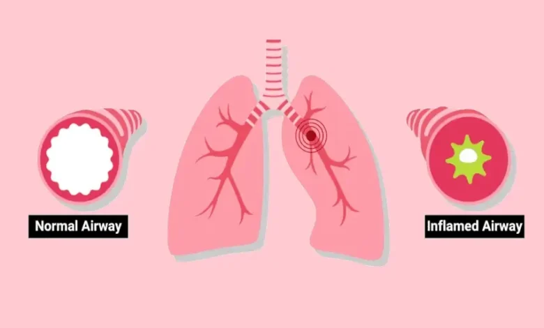 Is Bronchitis Contagious? Learn About Its Transmissibility