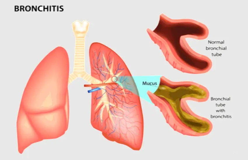 Is Bronchitis Contagious? Learn About Its Transmissibility