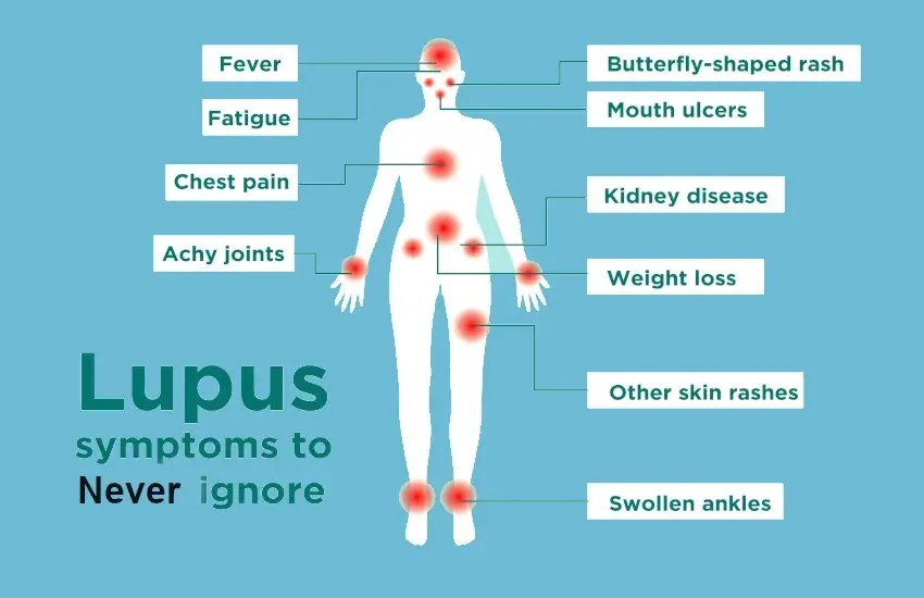 What Is Lupus? Understanding the Autoimmune Disease Basics