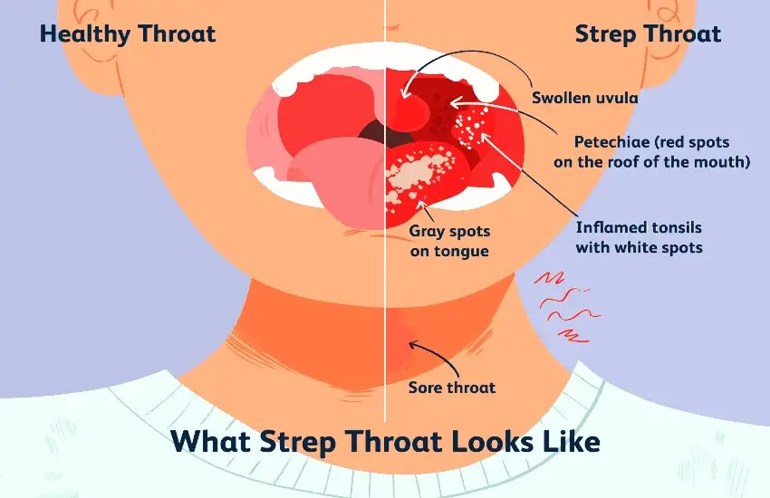 Is Strep Throat Contagious? Learn About Its Spread and Risks