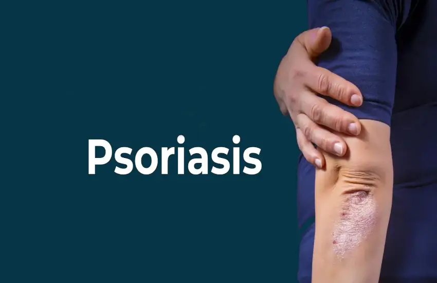 Understanding Psoriasis - Symptoms, Types, and Treatments