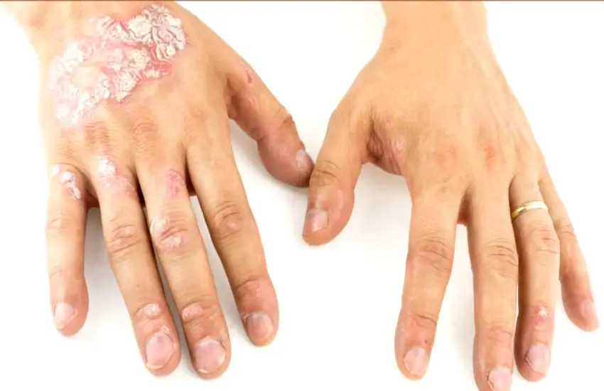 Understanding Psoriasis - Symptoms, Types, and Treatments