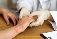 Understanding Psoriasis - Symptoms, Types, and Treatments