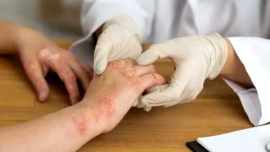 Understanding Psoriasis - Symptoms, Types, and Treatments