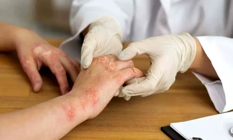 Understanding Psoriasis - Symptoms, Types, and Treatments